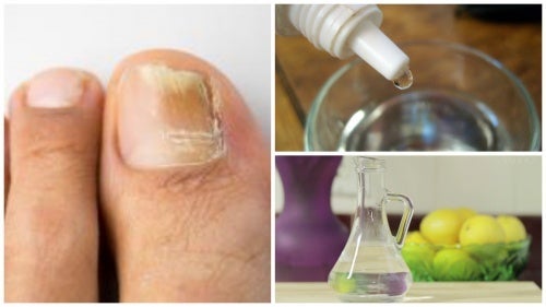 Направете си препарат за премахване на гъбички по ноктите