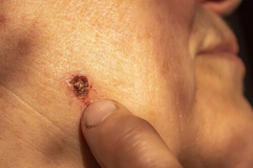 Базалноклетъчният карцином: най-честият рак на кожата
