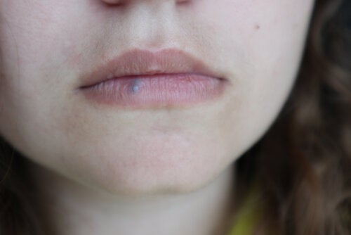 Рак на устните: причини, симптоми и лечение