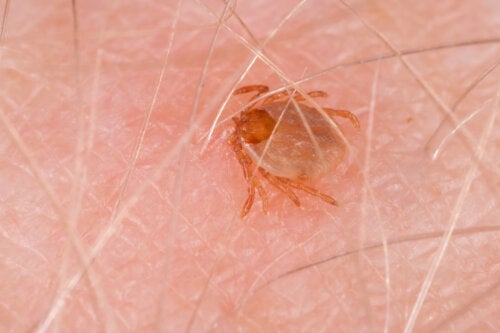 Петниста треска от Скалистите планини: Симптоми и лечение