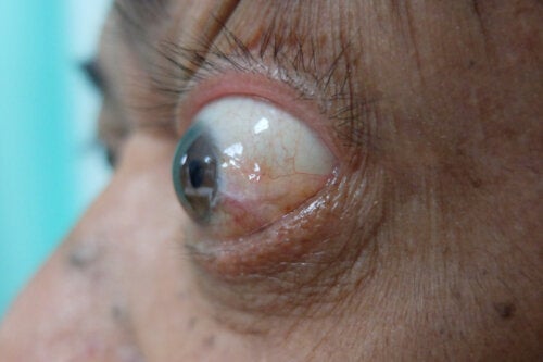 Болест на очите свързана със заболяването на щитовидната жлеза: Симптоми и лечение